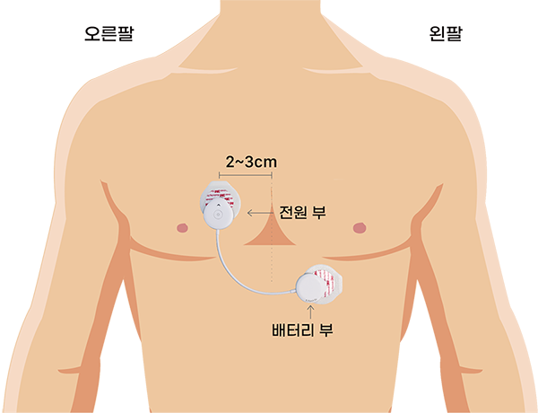 부착 방법 이미지