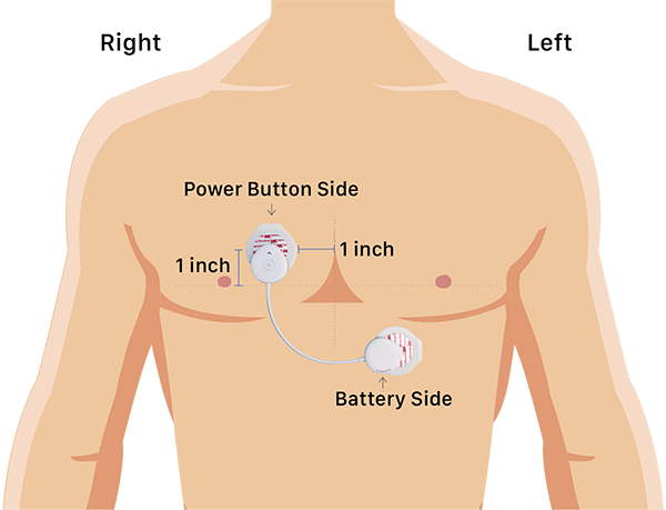 How to apply the S-Patch